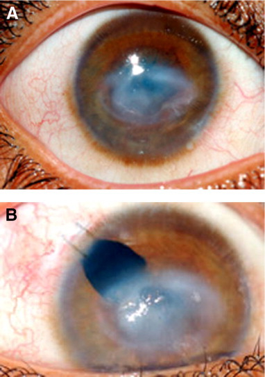 Optical Iridectomy In Children With Corneal Opacities 